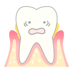 歯周病の歯のイラスト