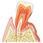 歯周病によるぐらつき