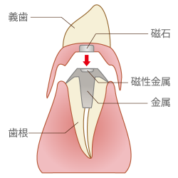 磁性アタッチメント義歯（マグネットデンチャー）