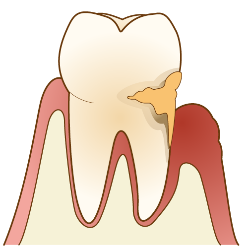 歯周病の歯