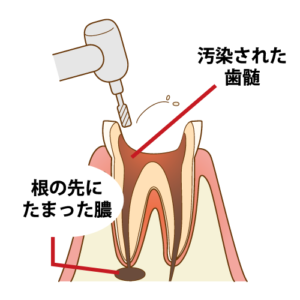 歯の根っこの治療（根管治療）