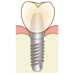 インプラント