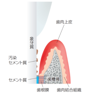 フラップ手術前
