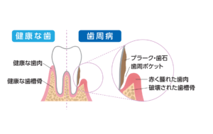 歯周病の進行