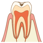 cavity001 C1エナメル質の虫歯