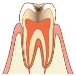 cavity002 C2象牙質に進んだ虫歯