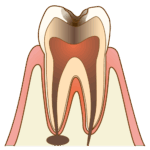 cavity004 C3(歯の神経にまで達した虫歯)